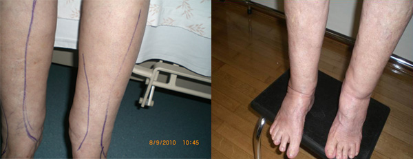 lipidima
