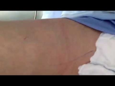 Θεραπεία κιρσών φλεβικής ανεπάρκειας με laser live