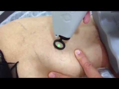 Live θεραπεία ευρυαγγειών κάτω άκρων με Laser